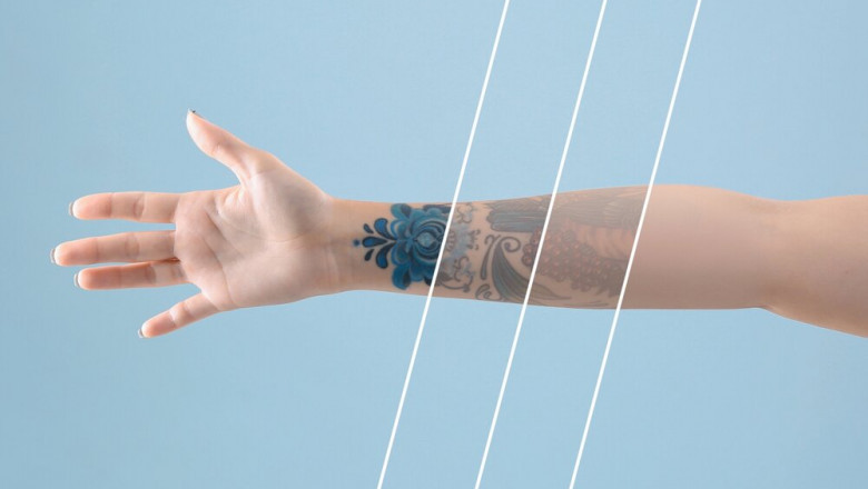 Comprehensive Study on Tattoo Removal Market 2021 with Top Leading Vendors like Cutera Cynosure, Lumenis