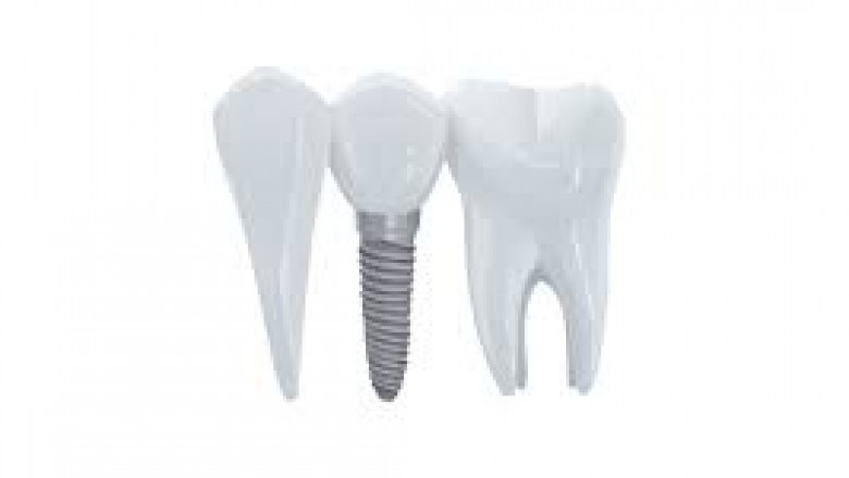 Global Bio-Implants Market Development Industry Trends Key Driven Factors Segmentation And Forecast To 2020-2030