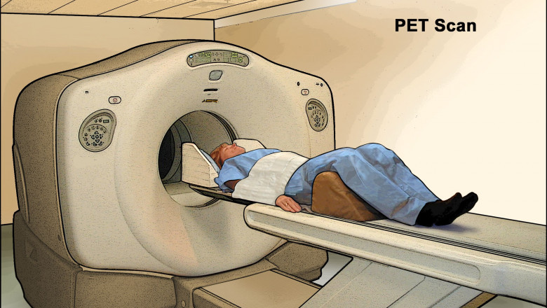 Non-small cell lung cancer treatment such as surgery and radiation therapy are used to target the tumor in patients