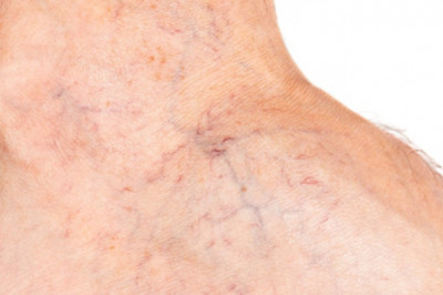 Spider Vein Treatment Center Near Me
