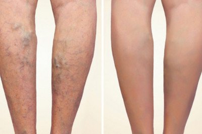 With the increasing prevalence of varicose veins, demand for Varicose Vein Treatment is also increasing with a rapid pace