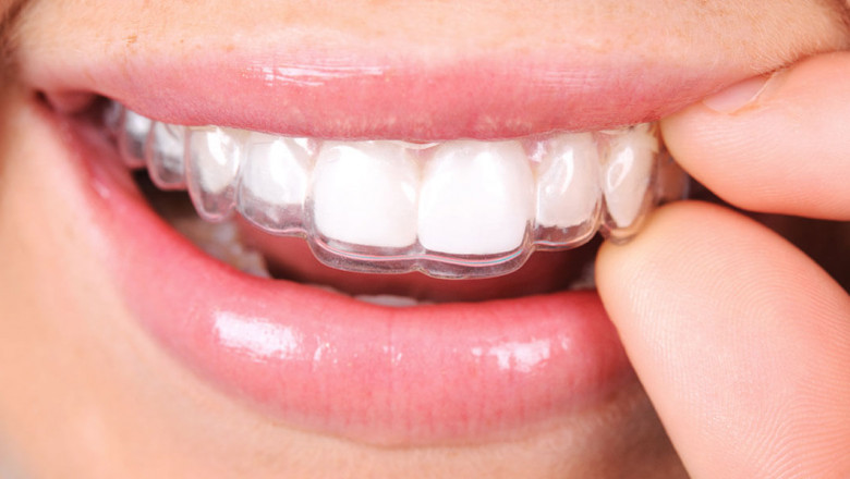 Dental Veneers: Porcelain VS Composite Veneers.