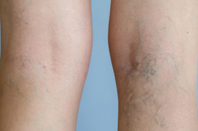 Spider Veins: Can You Get Rid Of Them Naturally?