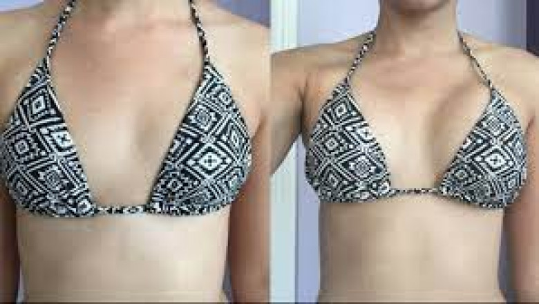 What Do You Need to Know About Breast Lift Surgery?