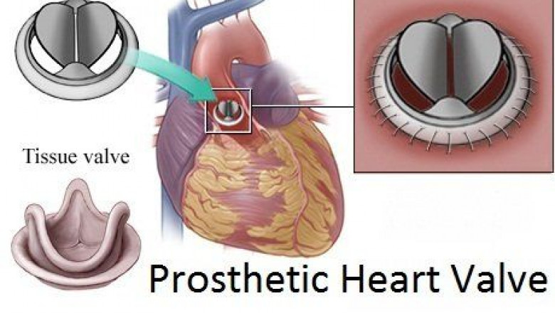 Prosthetic Heart Valves Market - Global Opportunity Analysis and Industry Forecast