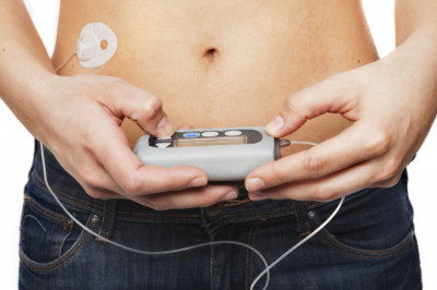 An Insulin Pumps administers insulin at a basal rate, in which a modest amount of insulin is supplied constantly throughout the day to maintain normal body
