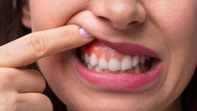 Cosmetic Tooth Bonding Near Me