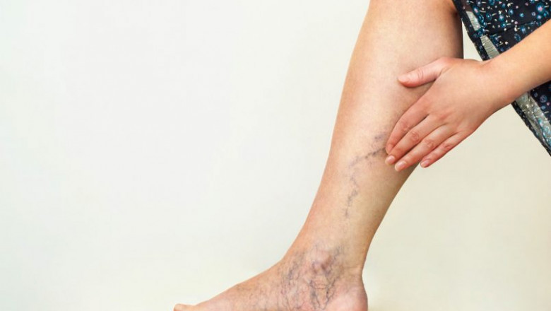 Harvard Trained Vein Doctor New York