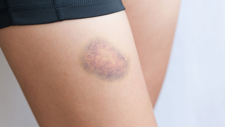How COVID-19 Increases the Risk of Blood Clots in Legs