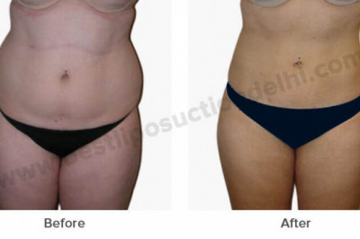Liposuction surgery in Delhi at LA Clinic