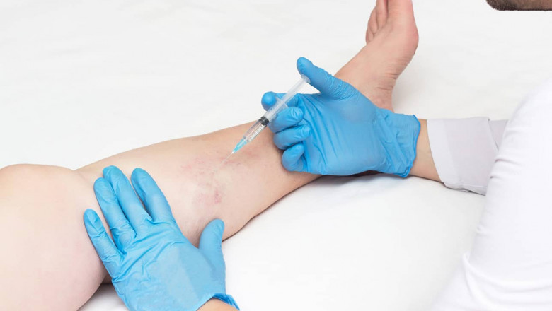 Searching For The Right Specialist For Vein Treatment!