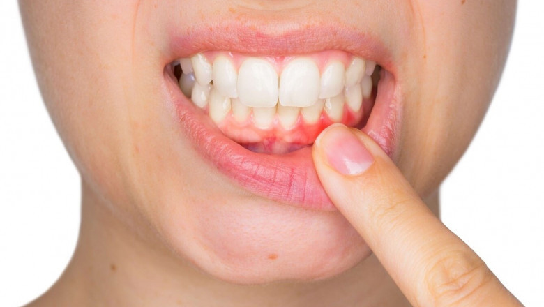 What Are The Major Symptoms Of Gum Disease