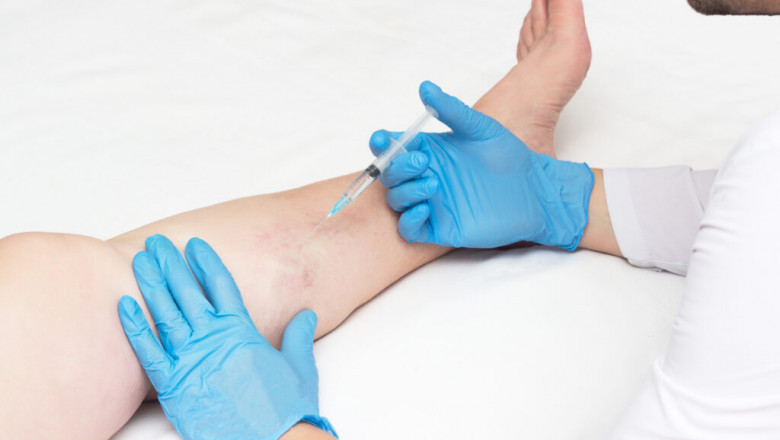 How Cold Weather Affects Veins Health?