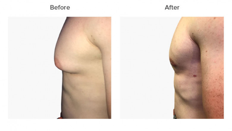 Gynecomastia Surgery in Delhi at LA Clinic
