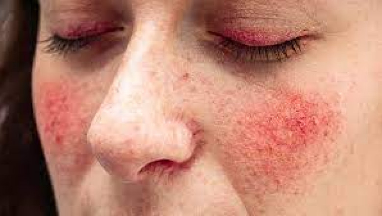 What activates rosacea?