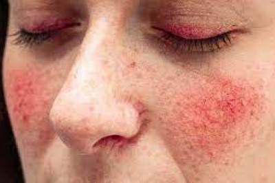 What is Type 2 rosacea?