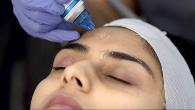 MICRODERMABRASION TREATMENT IN GURGAON