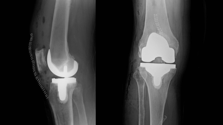 Veterinary Orthopedic Implant Market - Global Industry Analysis, Size, Share, Growth, Trends, and Forecast, 2018 – 2026
