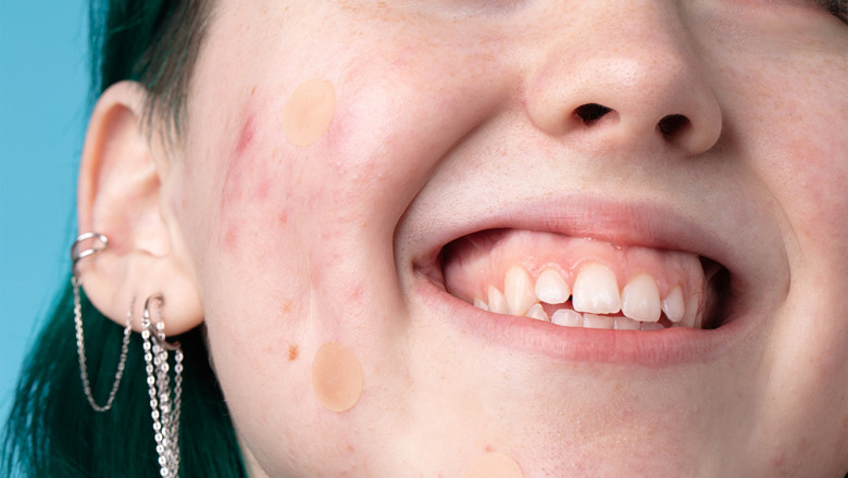 4 Tips for Facing Blemishes Throughout the Colder Months