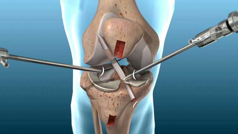 Knee Exercises