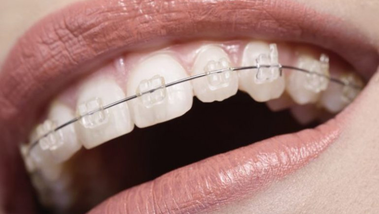 How Can Braces Help You Boost Your Confidence?