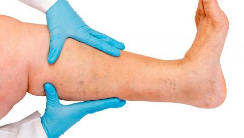 Prevent Your Varicose Veins During Pregnancy