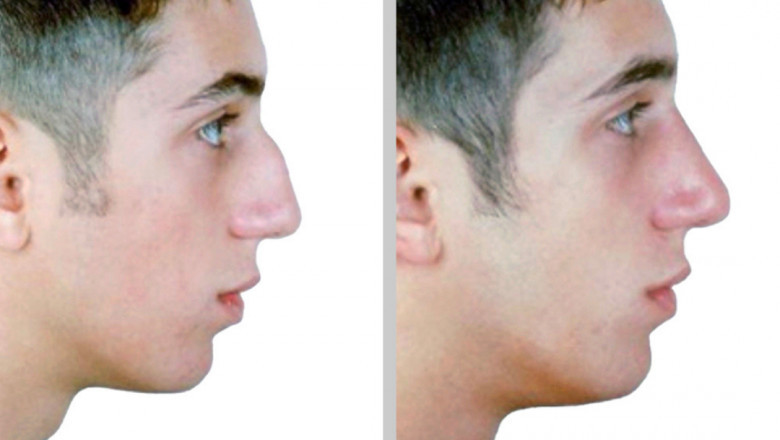 Experince desirable Ear surgery in SC