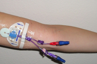 Peripheral Intravenous Catheters (PIVCs) are the most commonly utilised invasive devices