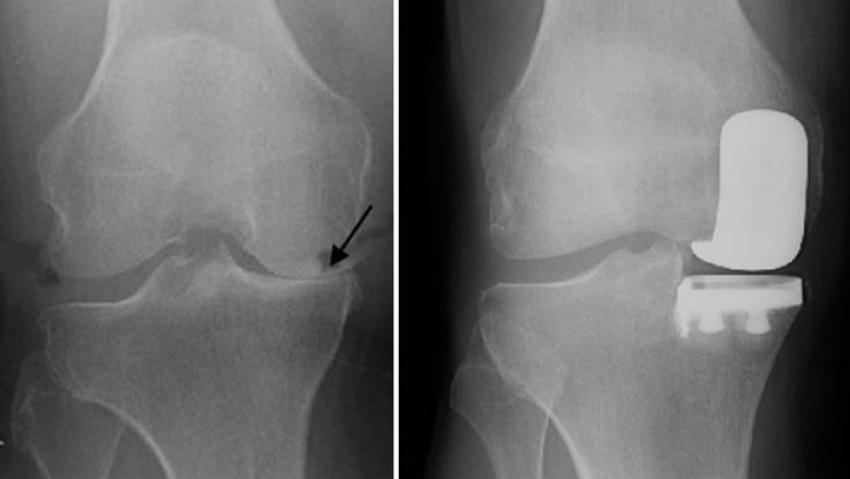 All about Partial Knee Replacement