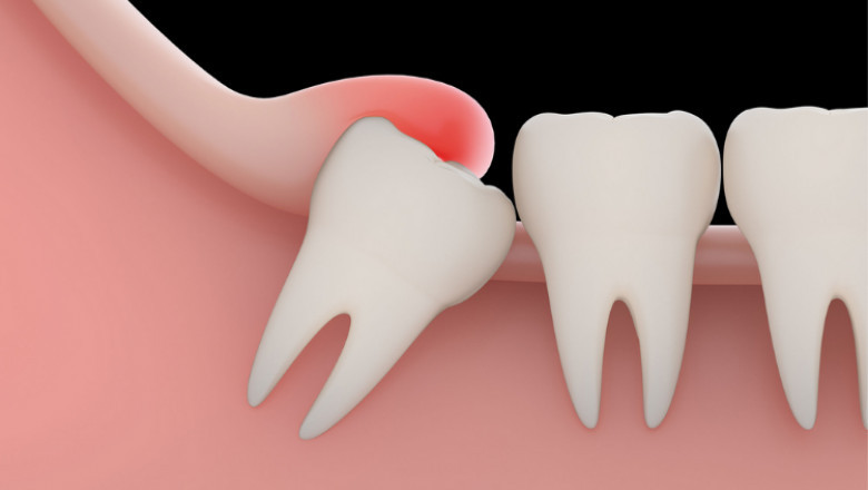 Wisdom Teeth Extraction in Houston