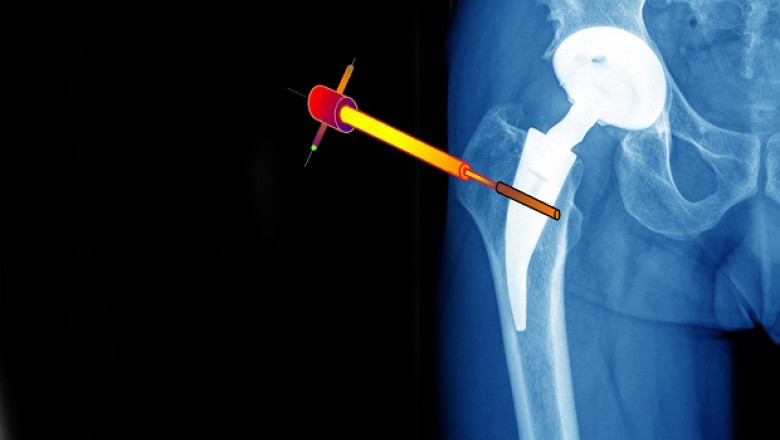 Orthopedic Navigation Systems Market 2021 - Technological Growth, Industry Status, Trends, Demand and Forecast to 2028