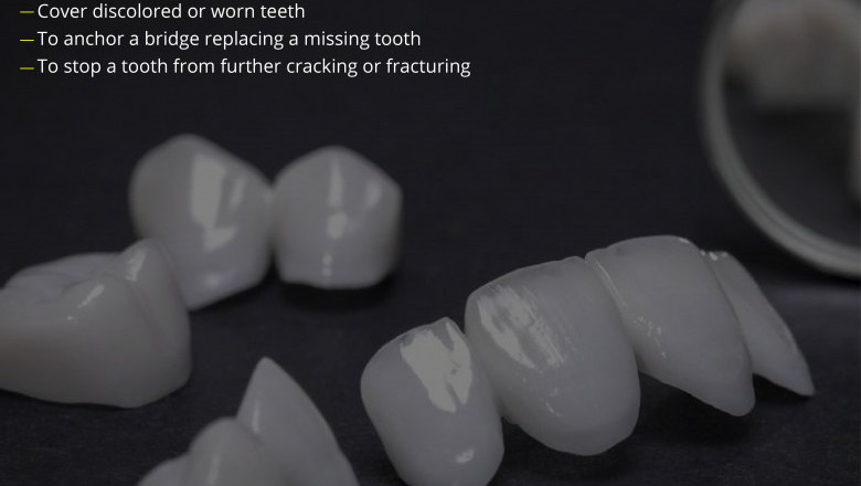 When Would I Need a Dental Crown? Emergency Dental Service
