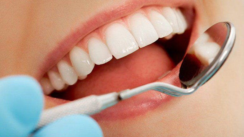 Dental Veneers: How To Get An Attractive Smile?
