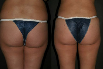 Get The Perfect Shaped Butts With BBL (Brazilian Butt Lift) Surgery: