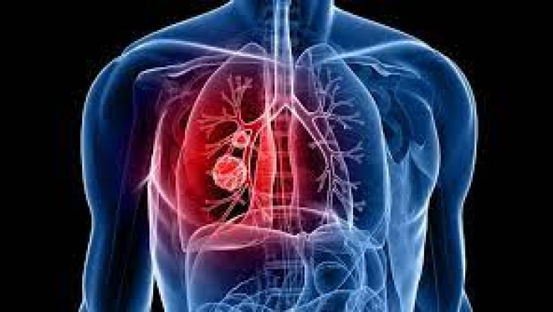 Lungs Cure Medicine - Obstructive Lung Disease Treatment
