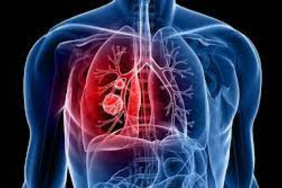 Lungs Cure Medicine - Obstructive Lung Disease Treatment