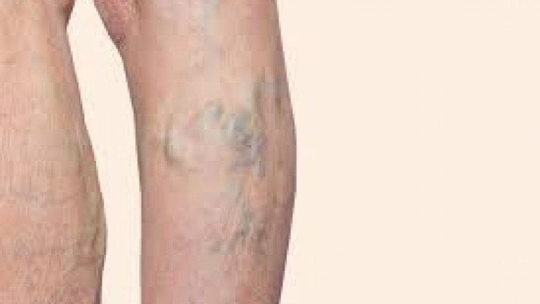 Spider Vein Treatment: How To Get Rid Of Facial Veins Effectively?