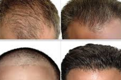 Is Hair Transplant Surgery Perfect in Summer?