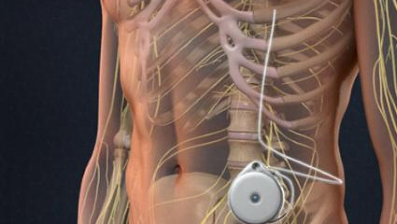 Intrathecal Pumps Market is Expected to Display Substantial Progress in the forecast 2021 to 2027 with COVID-19 Study