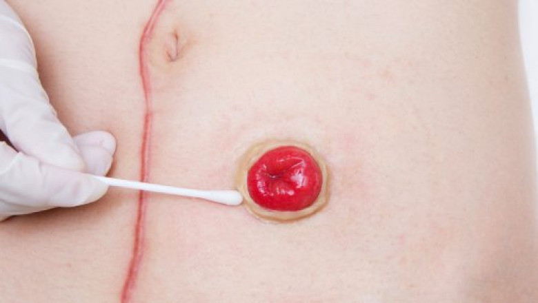Stoma/Ostomy Care Market Impacts, CAGR, Growth Factors and Forecast From 2021 to 2028