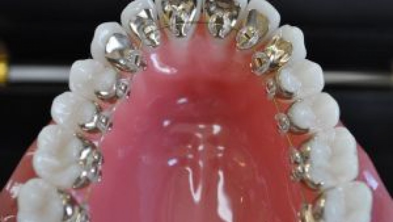 What are Lingual Braces