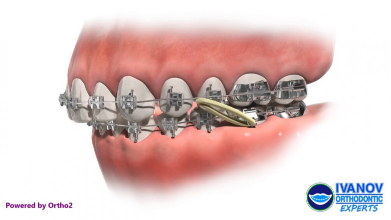 What are the Types of Treatment to Fix an Overbite?