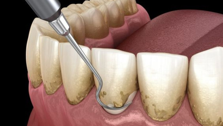 Benefits of a Dental Cleaning