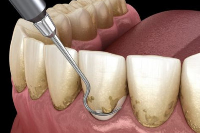 Benefits of a Dental Cleaning