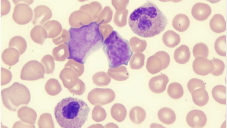 Myelodysplastic Syndrome Market 2021 Company Overview, Recent Developments and SWOT Analysis 2028