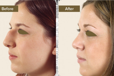 What is Rhinoplasty Treatment?