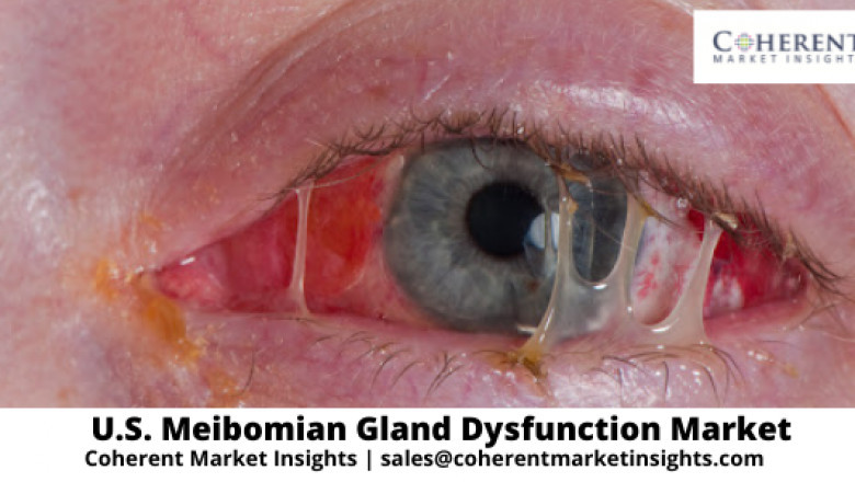 U.S. Meibomian Gland Dysfunction Market Size, Landscape, Industry Analysis, Business Outlook, Current and Future Growth