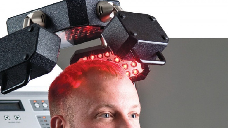 Hair Loss & Growth Treatment Market: Ready To Fly on high Growth Trends | Top Players are Ultrax Labs, Pharma Medico