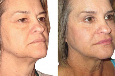 How Eye Lift Surgery Can Help You Get Rid Of Ageing Signs?