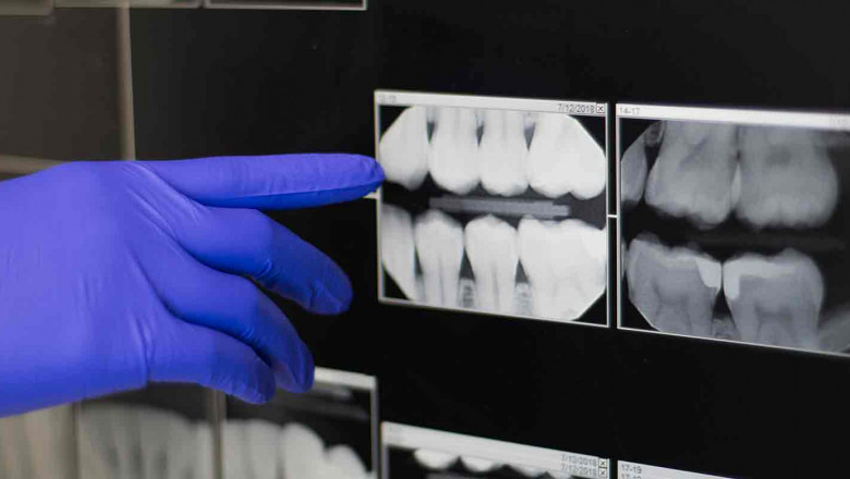 What Are The Advantage And Disadvantages Of Tooth Filling?